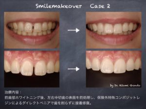 審美歯科治療 | 茗荷谷・大人の矯正歯科・審美歯科 小石川 ひとみ 